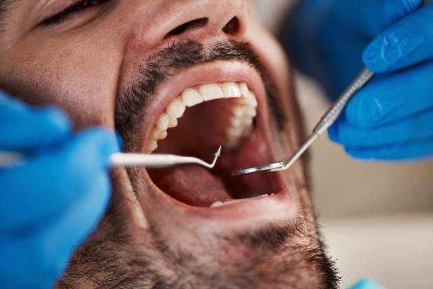 Best Emergency Dentist for Lost Fillings or Crowns in Greenville, PA